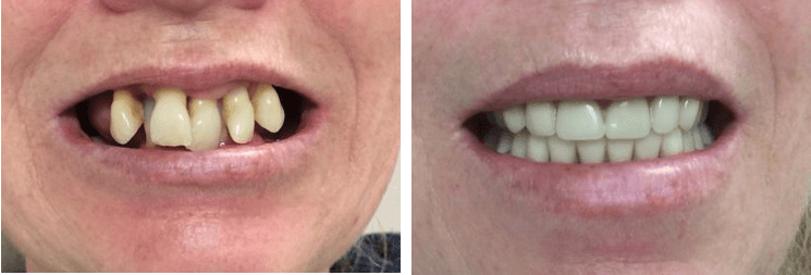 Immediate dentures 