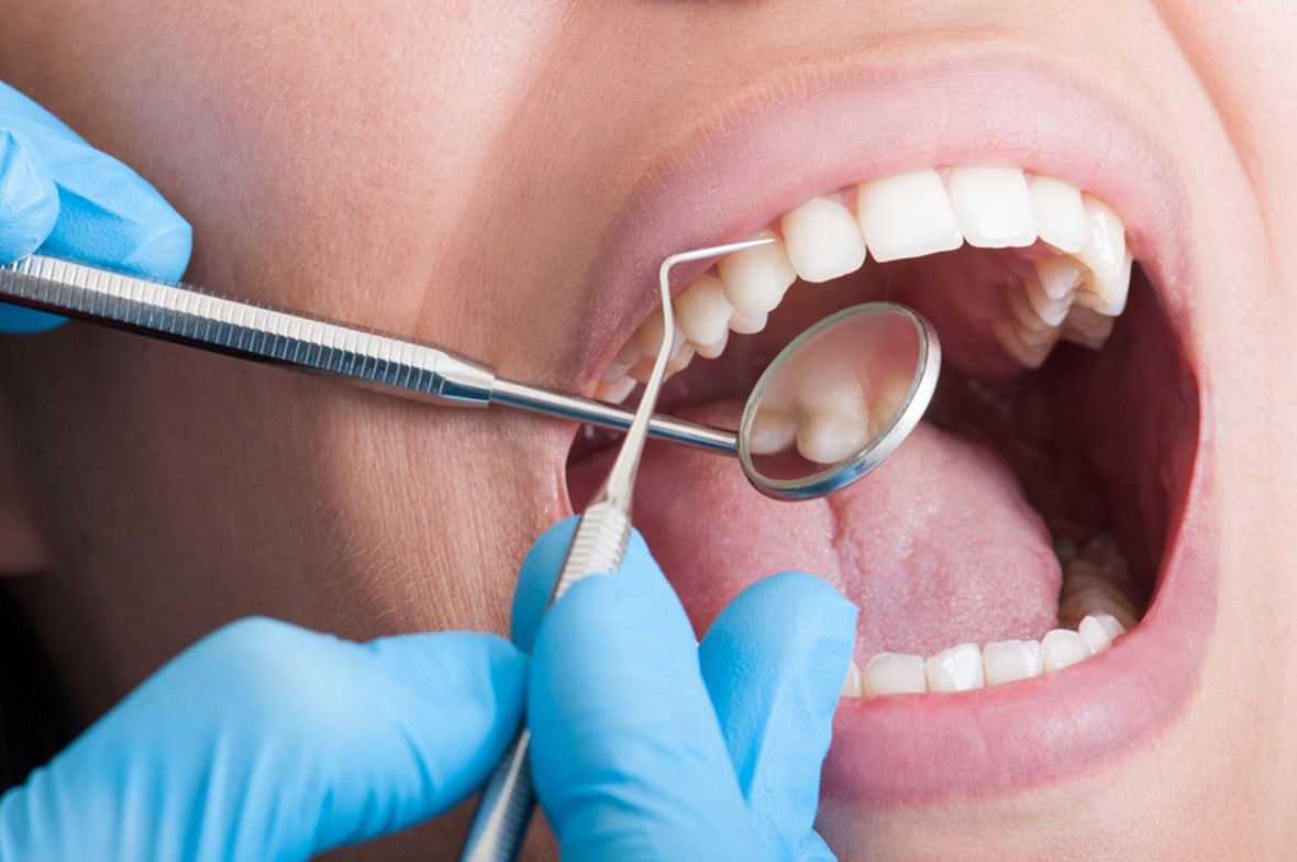 Surgical tooth extractions 